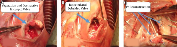 Surgical steps for Tricuspid valve reconstruction. A, Surgical view of the vegetation and destructive tricuspid valve; B, remnant of tricuspid valve after radical debridement; C, tricuspid valve reconstruction by pericardial patches and neochorda.