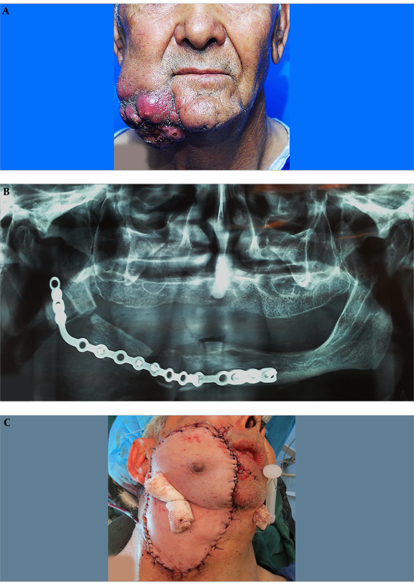 A, Extraoral view of the facial squamous cell carcinoma; B, Post-operative panoramic view shows the reconstructed mandible with plate and clavicle bone graft; C, The last photo of the patient in the operating room, with bolster packs for dead space reduction.