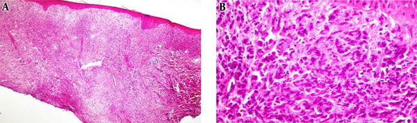 A, Low power examination of histiocytic sarcoma involving entire reticular dermis without epidermotropism (H & E, 4× magnification); B, medium power shows large cells with hyperchromatic nuclei and eosinophilic cytoplasm admixed with some small lymphocytes (H & E, 20× magnification).