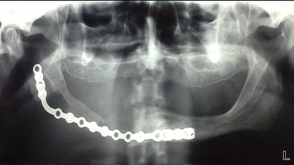 Panoramic view of the patient after 6 months; the clavicle bone has reached the mandibular body margins and underwent some resorption.