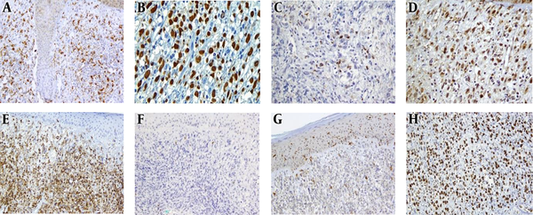 A, Immunohistochemistry staining shows positive immunoreaction for CD68; B, MUM1; C, lysozyme; D, S-100; E, LCA; F, and negative immunoreactivity for Granzyme; G, CD1a; and H, Ki-67 shows a high proliferative index of about 90%.