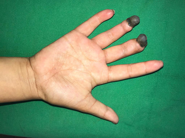 After 5 weeks of treatment-showing a reduction in edema, purpura but gangrene of distal part of digits