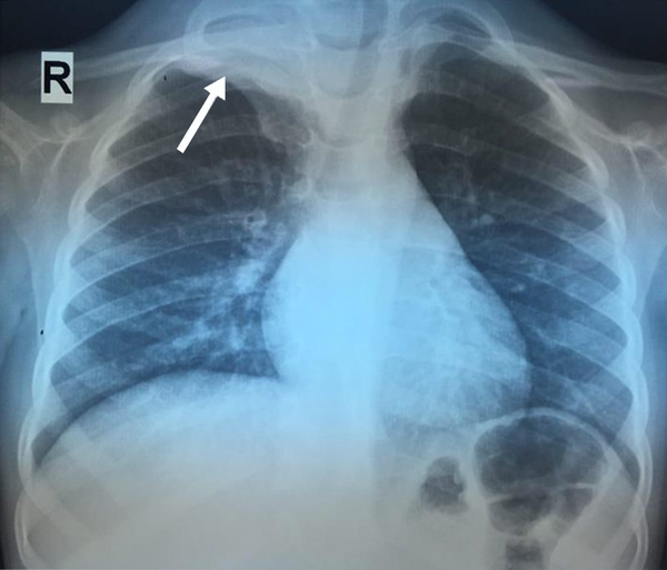 Chest X-ray shows a soft tissue mass in the apex of the right lung (arrow)