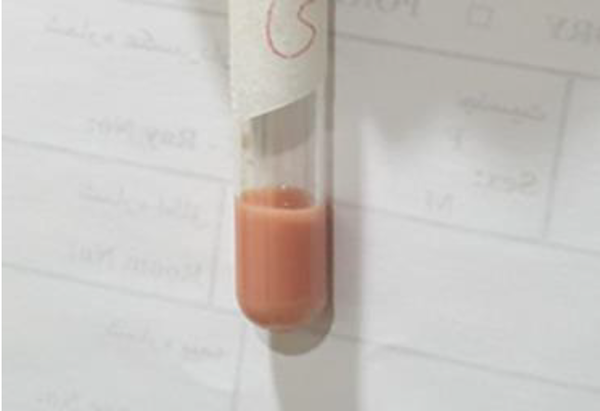 Blood sample of patient after centrifugation