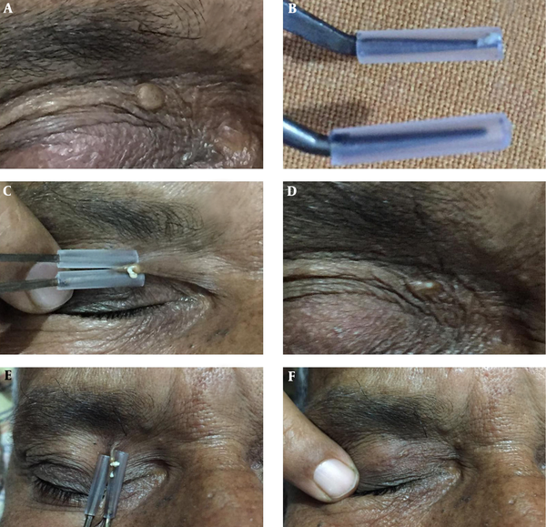 Surgical Pearl Dissecting Forceps with Polytube for Periorbital