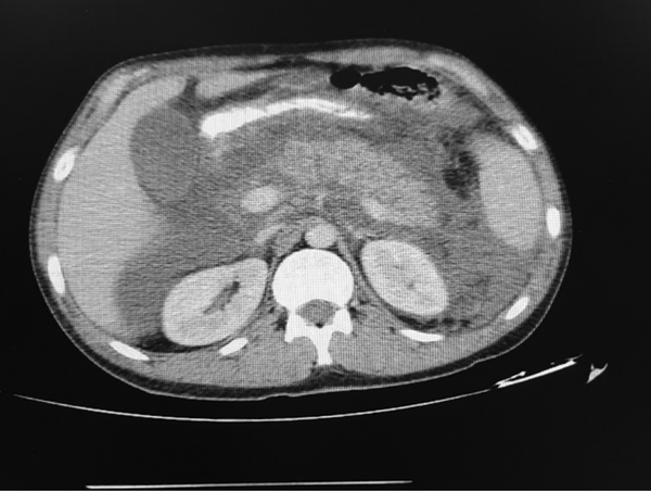 Edema and stranding of pancreatic tissue and peripancreatic showing pancreatitis. A focus of non enhancement seen in trunk of pancreas with volume of &lt; 30%, suggesting necrosis; evidence of acute necrosis seen in spaces of peripancreatic masses and with spread to paracolic gutters on both sides; evidence suggesting necrotizing pancreatitis).