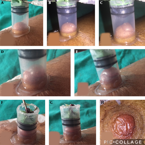 A-H, Suction syringe and its blister formation at its various stages.