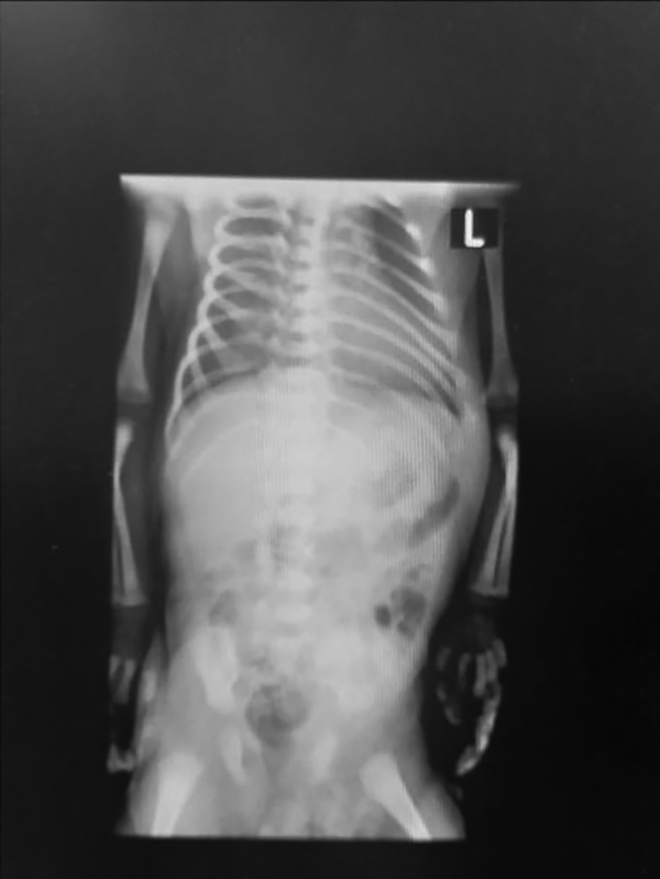 Chest X-Ray of the neonate in the first day of her life, relatively hyperinflation of both lungs without obvious infiltration is present.