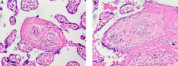 Histopathological features from the maternal side (A) and fetal side (B) suggesting syphilitic placentitis. (A) chorionic villous coated with floated trophoblastic cells within intervillous spaces and decidual tissues (400X magnification). Hypertrophic vascular and concentric vascular fibrosis with hyalinization is prominently found in both figures.