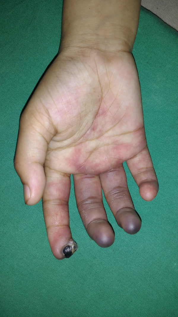 Right hand showing a bluish discoloration of digits and retiform purpura with edema