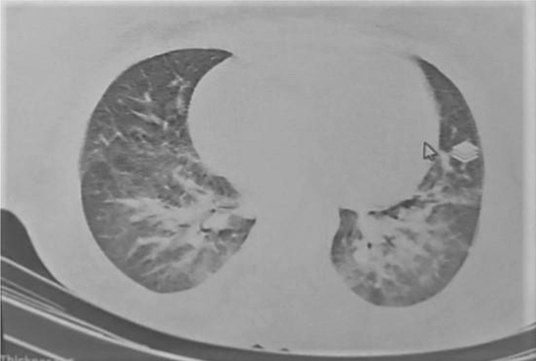 Maternal lung CT-Scan with multiple peripheral and severe periboronchovascular ground glass opacities in both lungs are seen, which is accompanied by hypervascularity and vascular dilatation in both sides in central and lower lobes, which could be in favor of viral pneumonia, including covid-19 infection.