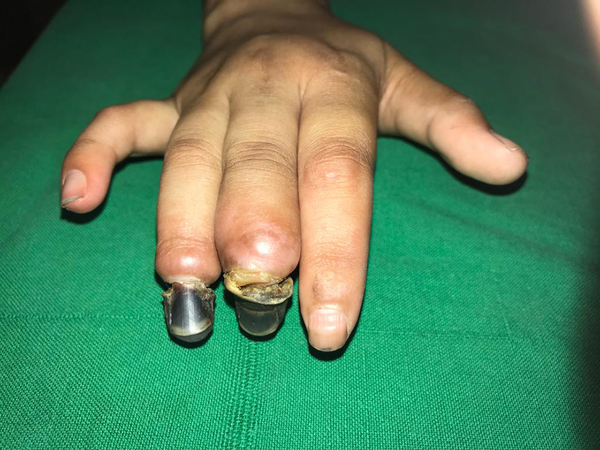 After 8 weeks of treatment-showing dry gangrene of digits with a discrete line of demarcation