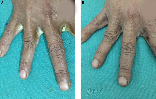 A, The clinically diagnosed candidal finger web intertrigo treated with sodium hypochlorite. B, The intertrigo resolved after 2 weeks.