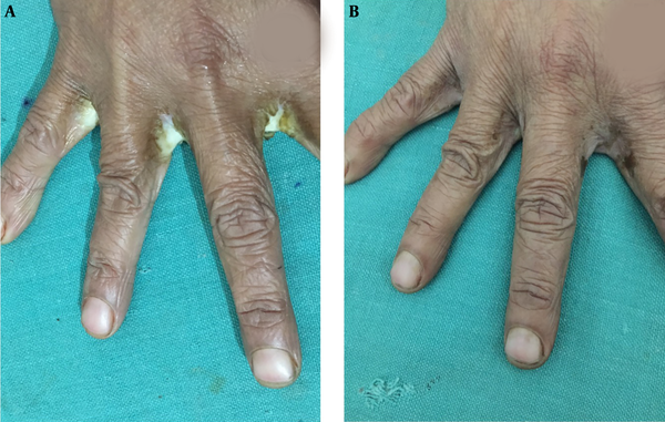 Therapeutic Pearl: A Simple Solution for Difficult Finger Web Intertrigo: A  Preliminary Report, Modern Care Journal