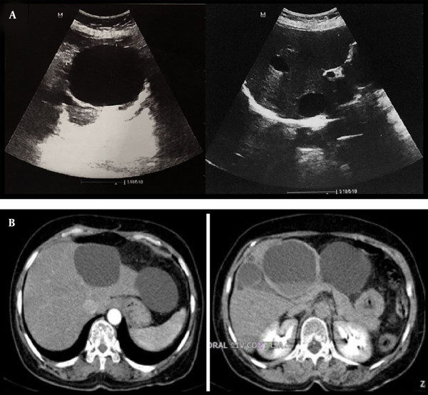 A, Transverse abdominal ultrasound images show anechoic cystic lesions involving both hepatic lobes and variable in size (largest 76 × 62 mm); B, Abdominal CT scan (arterial and delayed phase) reveals several thin-walled cystic lesions with variable size and a fluid-fluid level suggestive of hemorrhage surrounded by fat stranding in both lobes of the liver.