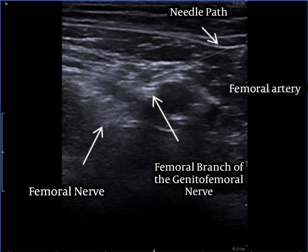 Ultrasound approach of the left genitofemoral nerve.