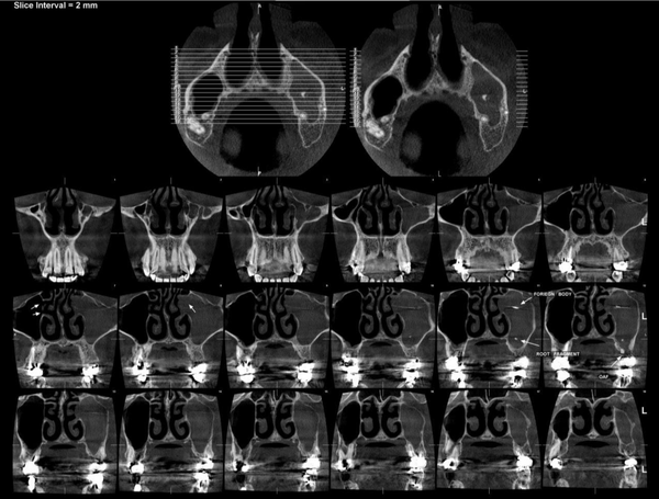 Coronal view with 2-mm slice intervals representing the complete opacification of the left maxillary sinus, the obstruction of the left ostium, root-fragment, and foreign body in the 11th section, and OAF in the 12th section
