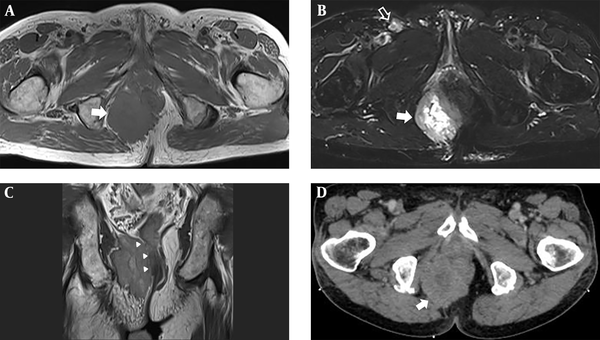 Metastatic tumor in the right perianal area. A, Axial T1-weighted image shows a mass with intermediate signal intensity (arrow); B, Axial fat suppressed T2-weighted half-Fourier single-shot turbo spin-echo (HASTE) image shows a central high signal intensity and peripheral intermediate signal intensity lesion (arrow). Note the enlarged right inguinal lymph node (empty arrow); C, Coronal proton-weighted image displays a large mass at the right ischiorectal/ischioanal fossa with invasion of the right external anal sphincter, puborectal, and levator ani muscles (arrowheads), and suspicious invasion of the internal anal sphincter; D, Contrast-enhanced axial CT image shows an irregularly shaped, heterogeneous enhancing mass in the right perianal area (arrow).