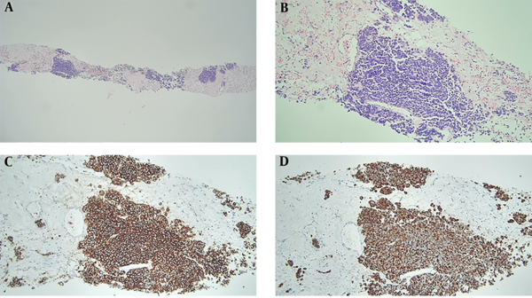 Histopathological features of perianal metastasis from small cell lung carcinoma. A, Specimen from the perianus is composed of nests of tumor cells with hyalinized stroma (hematoxylin and eosin, × 40); B, Tumor cells show fine chromatin with nuclear molding (hematoxylin and eosin, × 200); C and D, Tumor cells are positive for CD56 (C) and cytokeratin (D) on immunohistochemical staining (× 200).