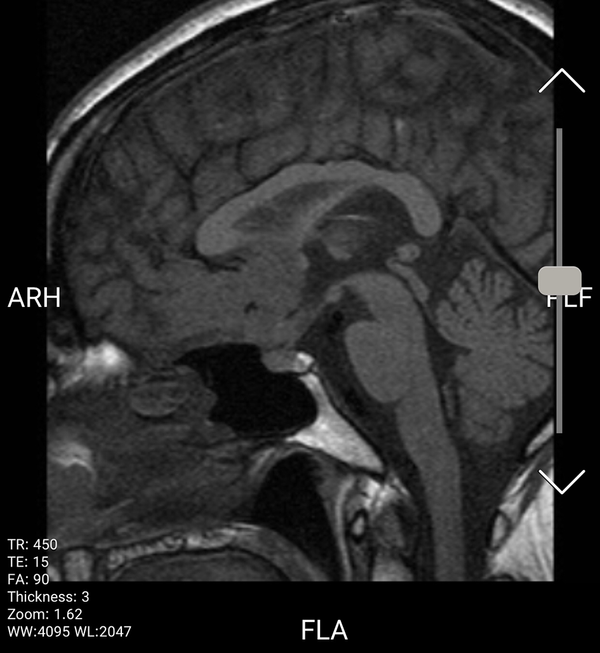 Sagital T1 image shows a lobulated isointense suprasellar mass with adhesion to base of inferior portion of frontal lobe and optic chiasm.