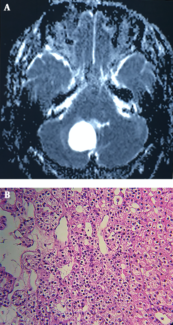 A, Brain MRI: A huge lobulated hyper-intense lesion measuring 48 by 38 by 28 mm in the right cerebellar hemisphere with significant projection into the fourth ventricle. B, Histopathologic sample of hemangioblastoma, reticular pattern