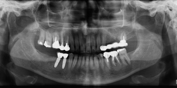 Panoramic view indicating the opacification of the left maxillary sinus and OAF in the 14th region