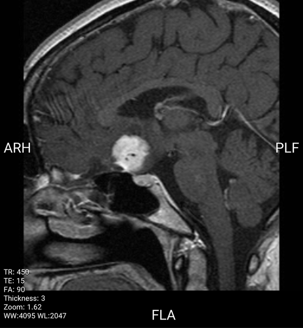 Sagital T1 post contrast shows strong enhancement of tumor and dural tale.