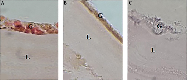Histological changes in the hydatid cyst wall. A) After exposing the cyst to phosphate buffer solution, the germinal layer and its nuclei were clear, and the laminated layer was uniform and clear. B) After exposing the cyst to 100% concentration (0.49 gr/mL) of crude extract herbal extract, the germinal layer was found to be unclear, and its nuclei had disappeared. The laminated layer was also uneven and rough. C) By exposing the cyst to 100% concentration (1.35 gr/mL) of the flavonoid extract, the germinal layer was found to be completely destroyed, and the laminated layer was rough, curved, and uneven.