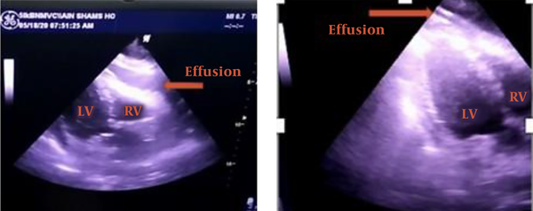On the left is an echocardiograph of a subcostal coronal view of the heart showing pericardial effusion. On the right, we have the same view after pericardiocentesis with no visible effusion (LV, left ventricle; RV, right ventricle).