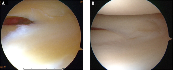 Knee arthroscopic finding: A, Transverse tear; B, Oblique tear progressing toward the direction of posterior segment. Tears are observed in the middle segment of the lateral meniscus.