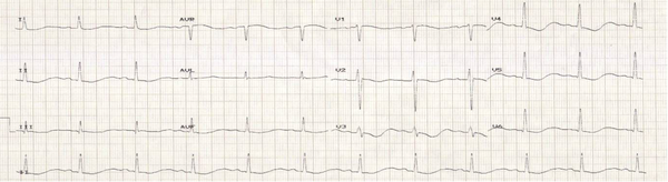 ECG showing flattened T Waves and prolonged QT interval.