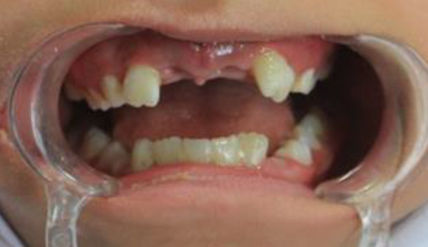 Frontal view of avulsed teeth
