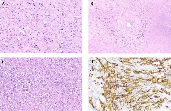 (A) Myxohyaline stroma embedding tumor cells, some with intracytoplasmic vascular spaces filled by red blood cells (H&amp;E, x400). (B) The infiltrating tumor cells are surrounded by a necrotic and hyalinized matrix at the periphery. A central vein residue is seen in the center of the picture (H&amp;E, x100). (C) Area of the tumor showing marked cellularity with a moderate degree of atypia (H&amp;E, x100). (D) Positive membranous staining with CD34 (x400).