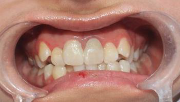 Frontal view of replanted teeth after 3-year follow-up