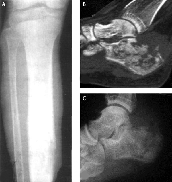 Osteosclerotic and mixed type. A, Osteosclerosis is shown in the middle segment of the tibia with local bone destruction; B and C, Mixed type is shown in the calcaneus with “floating-ice” destruction, pathological fracture and a soft tissue mass.