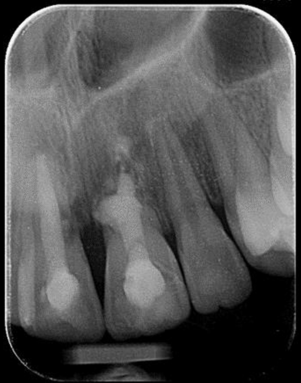 Periapical radiographs view after 3-year follow-up