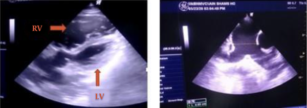 The left photo shows a modified apical 5 chamber view with a severely dilated RV compressing the LV (LV, left ventricle; RV, right ventricle). The right photo shows a short-axis view at the level of the great vessels showing a dilated pulmonary trunk: 4.9 cm and branches with no visible thrombi.
