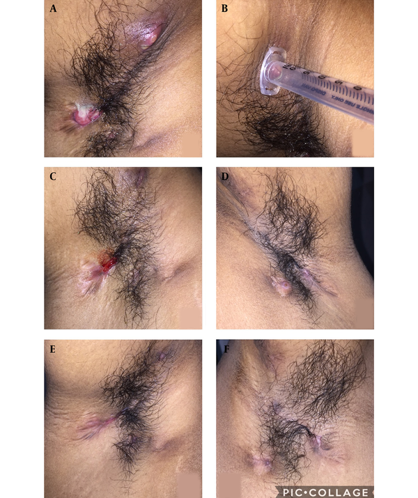 A, discharging nodules and sinuses of HS in axilla; B, the abscess of the HS lesions was being drained with the help of disposable syringe barrel; C and D, partially responsive HS after three months of the treatment; E and F, healed lesions of HS after topical application of NaOCl along with oral treatment at the end of 4th month of follow-up.