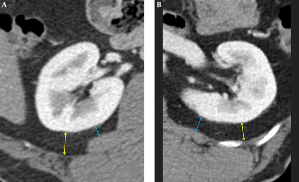 Two different methods for measuring posterior perinephric fat thickness (PPFT) in two different patients (A, B). PPFTcostal: yellow arrows; PPFTlumborum: blue arrows.