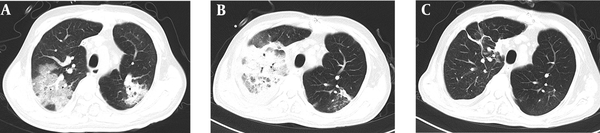 Computed axial tomography of chest. The image of CT scans on POD 31 (A), POD 31(B), and POD 85 (C).