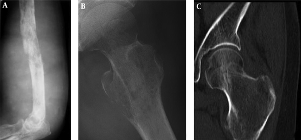 Infiltrative and osteolytic destruction. A, Infiltrative bone destruction is shown in the humerus; B and C, Osteolytic destruction is shown in the proximal end of the femur in the plain radiograph (B) and computed tomography (C).
