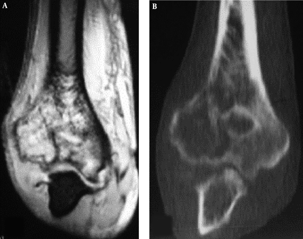 Osteolytic destruction in right humerus. A, Magnetic resonance imaging; B, Computed tomography. Osteolytic destruction is shown in the distal humerus with discontinued bone cortex, invasion of the articular surface and increased density of the surrounding soft tissue. Magnetic resonance imaging shows a greater extent than the computed tomographic scan.