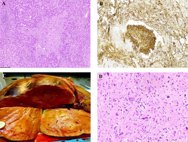 (A) A densely fibromyxoid tumor stroma with irregular borders infiltrates the adjacent liver parenchyma (H&amp;E, x40). (B)Immunohistochemical staining with CD34 highlights the tumor intravascular tuft proliferation (IHC, x100). (C) Liver sections show multiple ill-defined cream-colored nodules with a focus of infiltration and retraction of the liver capsule. (D) A sclerotic matrix enclosing epithelioid and stellate dendritic cells. At the center of the field, an epithelioid tumor cell with an intracytoplasmic vacuole is seen, giving the cell a signet ring-like appearance (H&amp;E, x400).