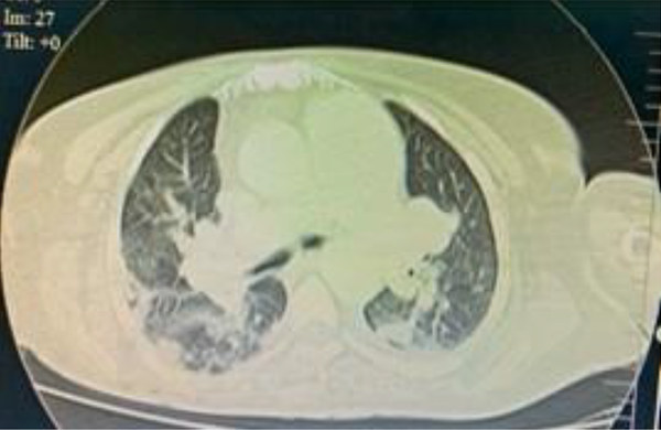 Computed tomography of the chest showing a right middle lobar segmental branch occlusion consistent with thrombosis.