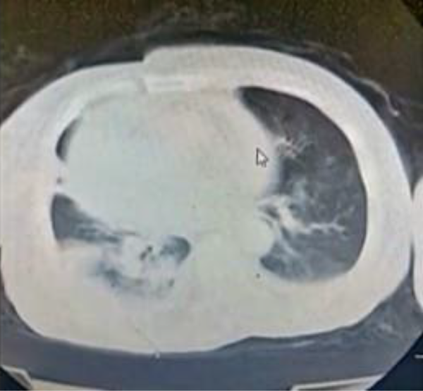 Computed tomography of the chest showing bilateral ground-glass appearance, mild right-sided pleural effusion, and enlarged cardiac silhouette (likely pericardial effusion).