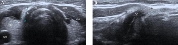 (A) Transverse image of the right pyramidal lobe detected on thyroid US in a 6-year-old female patient. The PL shows hyperechogenicity to adjacent muscles and homogeneous parenchymal echogenicity. A- maximum transverse diameter. B- maximum anteroposterior diameter. (B) Sagittal view shows the maximum longitudinal diameter of the PL. TRL-thyroid right lobe. TLL-thyroid left lobe. SHM - sternohyoid muscle. STM - sternothyroid muscle. T - trachea. AMI - air-mucosa interface. CC - cricoid cartilage. CCA - common carotid artery. S - strap muscles.
