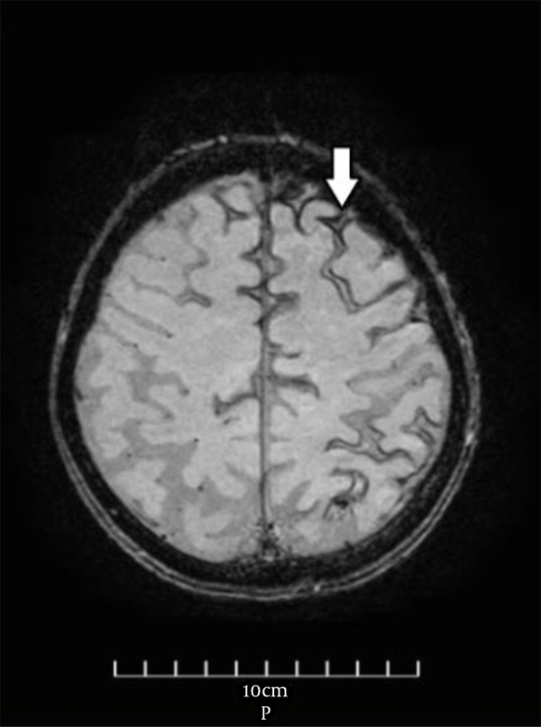 Brain MRI (susceptibility-weighted image sequence) shows linear blooming artifact (white arrow) in accordance with blood products in the subarachnoid spaces of the high left frontal convexity region.