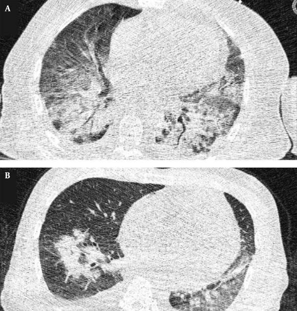 A and B, Indeterminate CT imaging features of COVID-19. Unenhanced thin-section axial image of the lungs in a patient with a positive RT-PCR shows bilateral ground glass opacity (GGO) with consolidation, without a specific distribution (non-rounded or non-peripheral) associated with bilateral pleural effusion.
