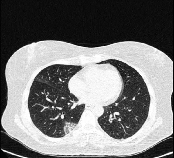 Typical CT imaging features of COVID-19. Unenhanced thin-section axial image of the lungs in a patient with a positive RT-PCR shows peripheral ground glass opacity (GGO) with a crazy paving pattern and reverse halo sign.