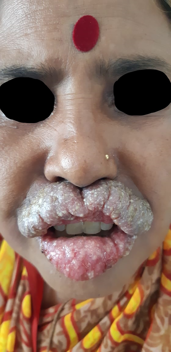 Upper and lower lips show vegetative plaques with overlying fissures with areas of erosions, fresh bleeding points, oozing, and yellowish crusts extending beyond vermillion border.